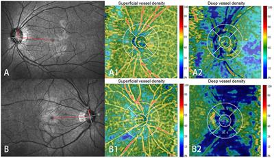 Analysis of the relationship between axial length, optic disc morphology, and regional variations in retinal vessel density in young adults with healthy eyes